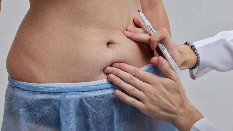 Quelle alimentation après une abdominoplastie ?