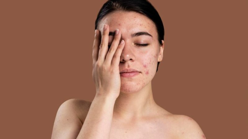 Comment se passe un traitement de l’acné en médecine esthétique ?