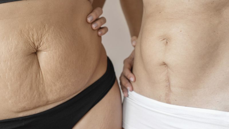 Se décider pleinement pour une abdominoplastie en 2026