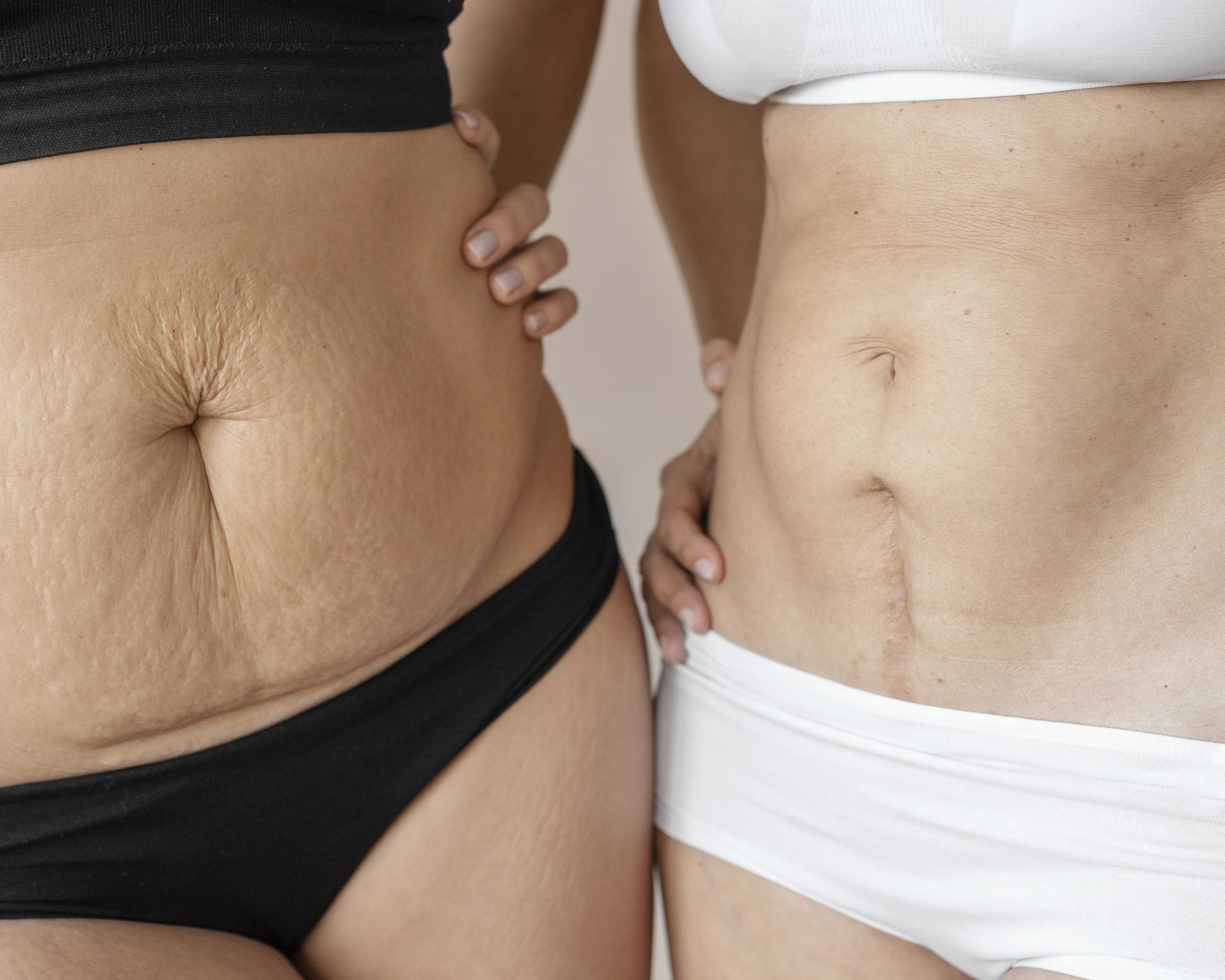 Se décider pleinement pour une abdominoplastie en 2026
