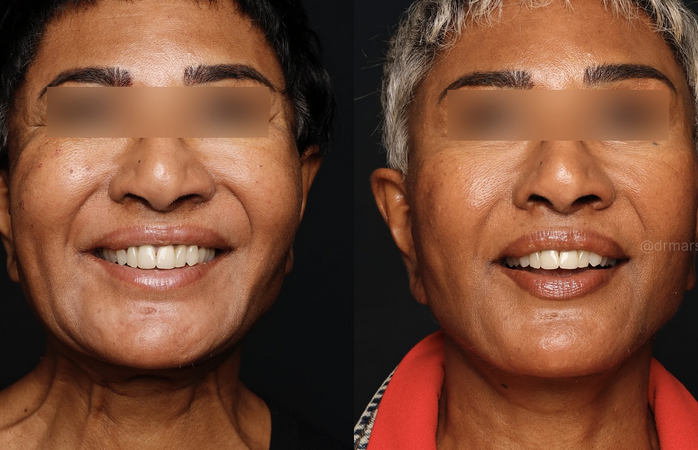 Comment se met en place la convalescence après le lifting deep plane