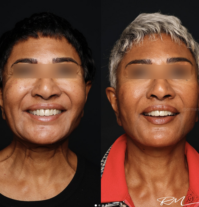 Comment se met en place la convalescence après le lifting deep plane